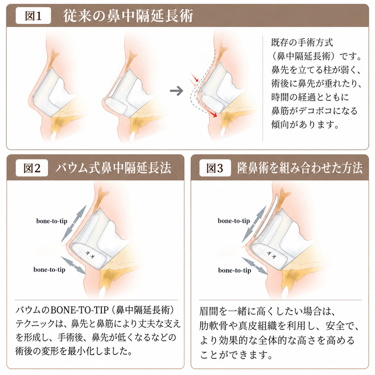 無プロテーゼ鼻中隔延長術とは？